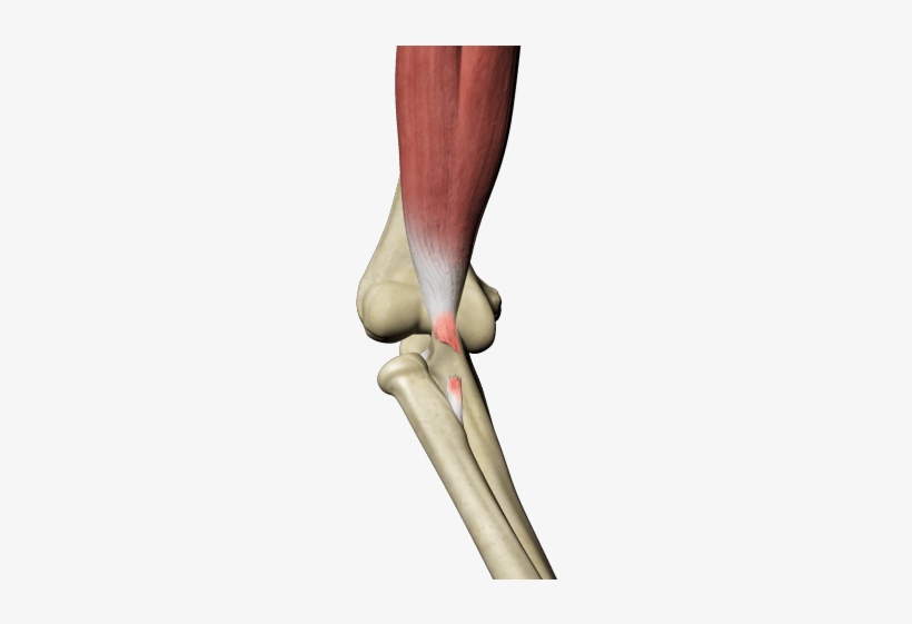 Biceps Tendon Tear - Diatal Biceps Tendon Rupture, transparent png #288769