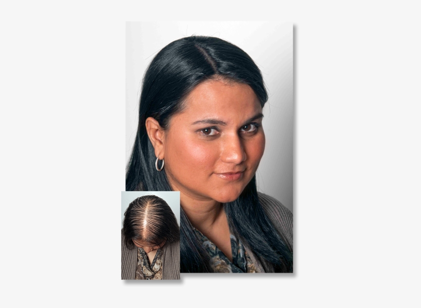 Thinning Hair - Does Thinning Hair Look Like Female, transparent png #2802179