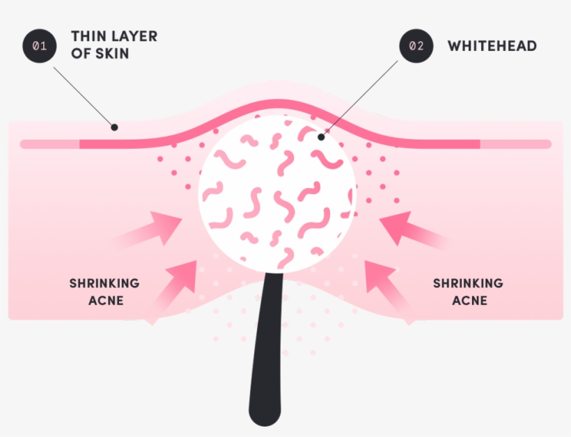 Death Of The Pimple - Acne, transparent png #2882056