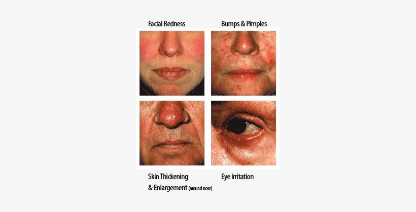 Many People Notice That Their Rosacea “flares” Or Symptoms - Red Face Stress, transparent png #2882121