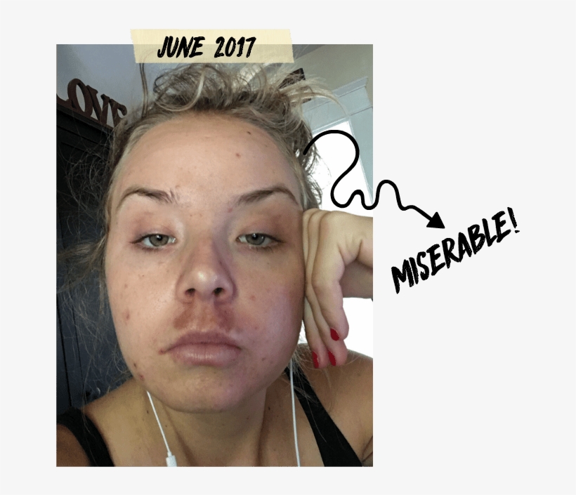 Those Little Popped Pimples You See Up There Turns - Melasma Mustache, transparent png #2882210