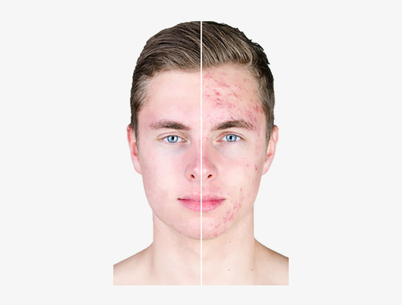 What Are Acne Treatments - Puberty Acne, transparent png #2882309