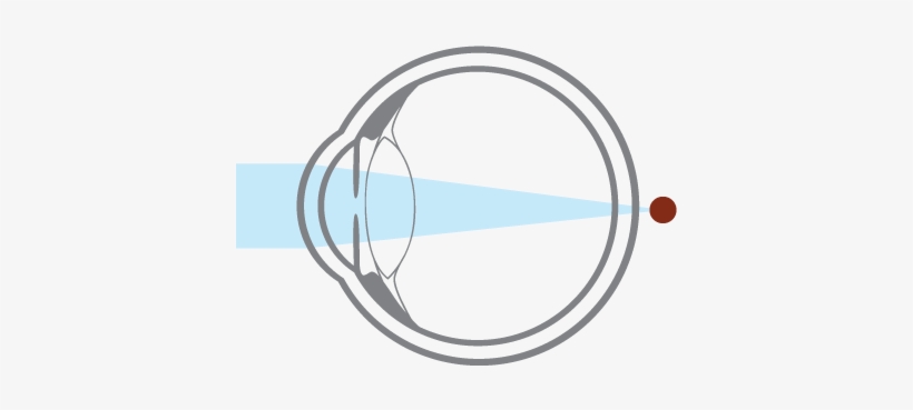 Hyperopia, Or Farsightedness, Occurs When An Eyeball - Circle, transparent png #2895199