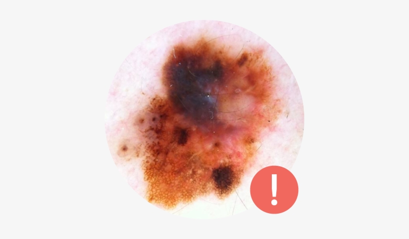 Cancerous Mole - Multi Colour Mole, transparent png #293636