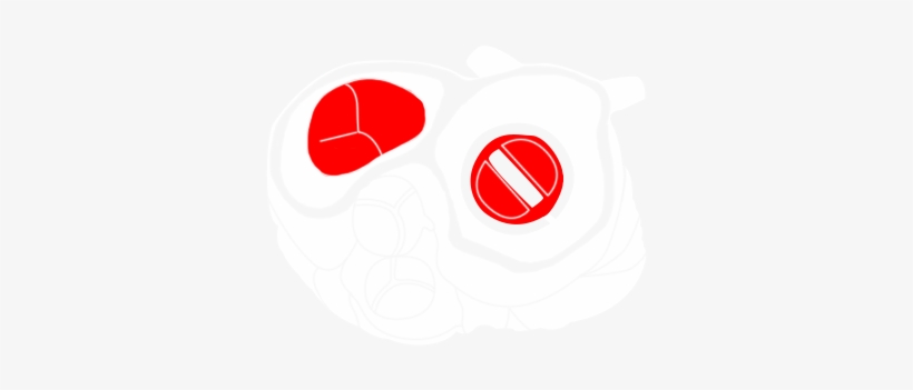 Valve Surgery - Illustration, transparent png #2920220