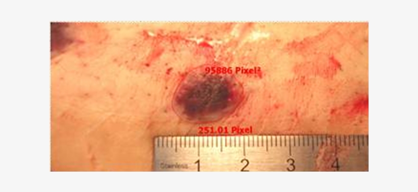Determination Of The Area Of The Bruise In Pixel2 After - Blood, transparent png #2928324