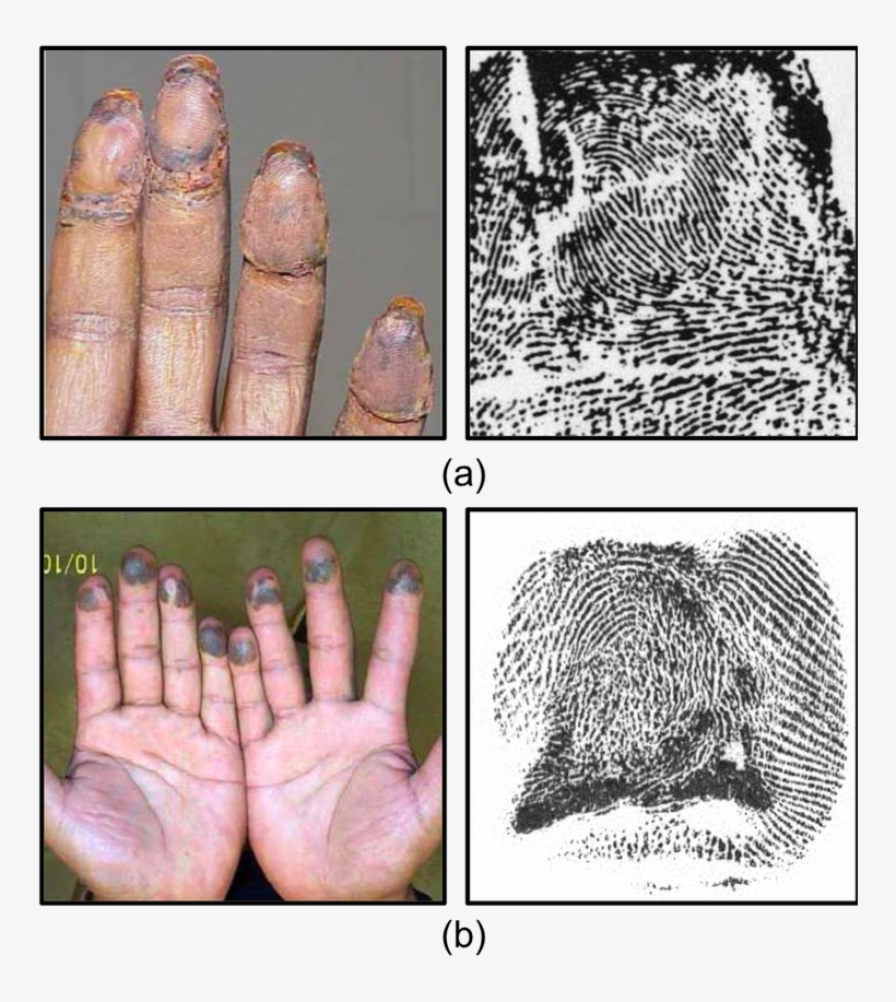 Example Images Of Altered Fingerprints - Fingerprint Alteration, transparent png #2933515