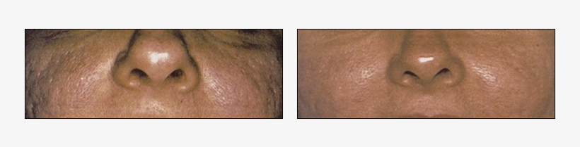 Acne Scar Treatment Results At Ablon Skin Institute - Ablon Skin Institute & Research Center, transparent png #2967993