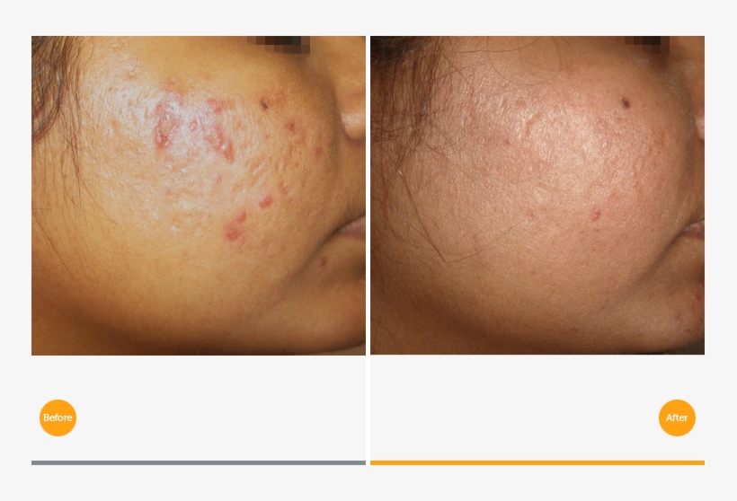 Acne Scar Revision After Tixel Treatment At Canary - Tixel For Acne Scars, transparent png #2968016