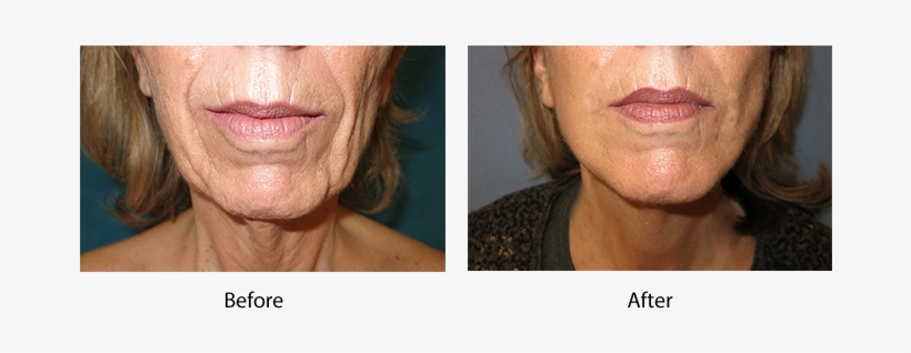 Click Here For Before And After Photos - Surfer Hair, transparent png #2968096