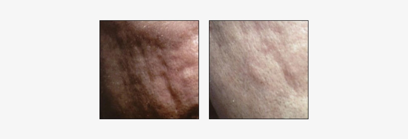 Acne Scar Treatment Results At Ablon Skin Institute - Scar, transparent png #2968198