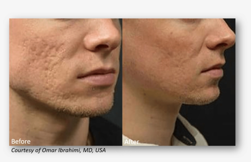 Benefits Of Infini Rf Microneedling - Results Of Rf Microneedling, transparent png #2968305