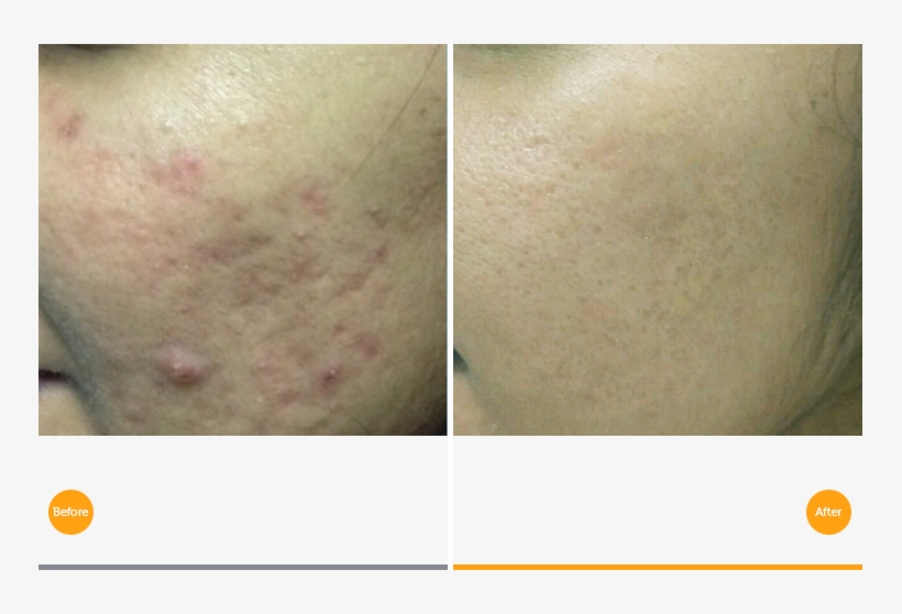 Acne Scars Treatment - Tixel Before And After Acne Scars, transparent png #2968361