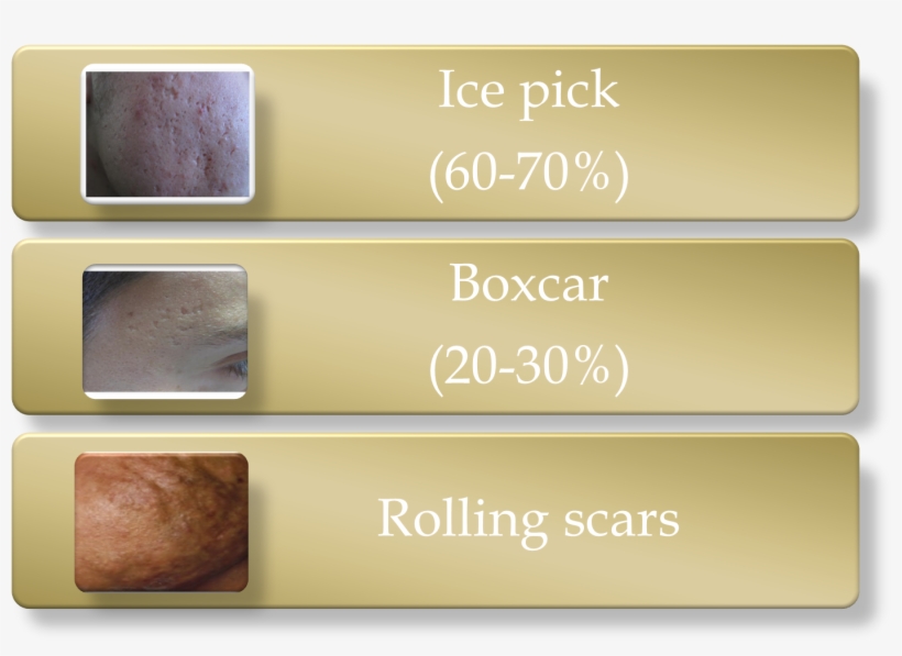 Picture14 - Boxcar Ice Pick Scars, transparent png #2968501