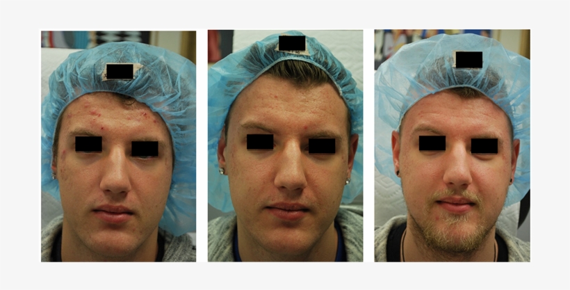 Acne And Acne Scarring And Pores Before , 2 Months - Acne, transparent png #2968532