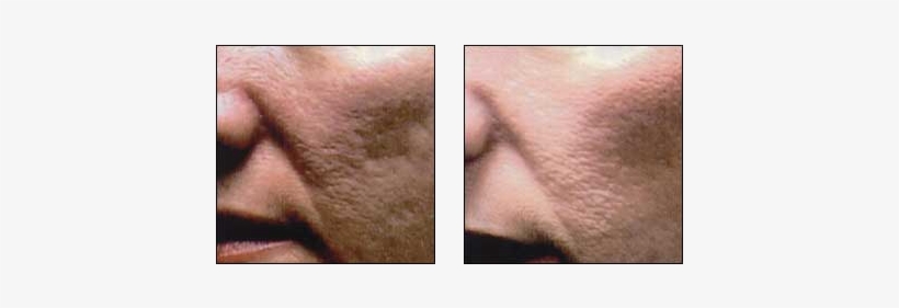 Acne Scar Treatments By Dr - Dr. Glynis R. Ablon, Md, transparent png #2968689