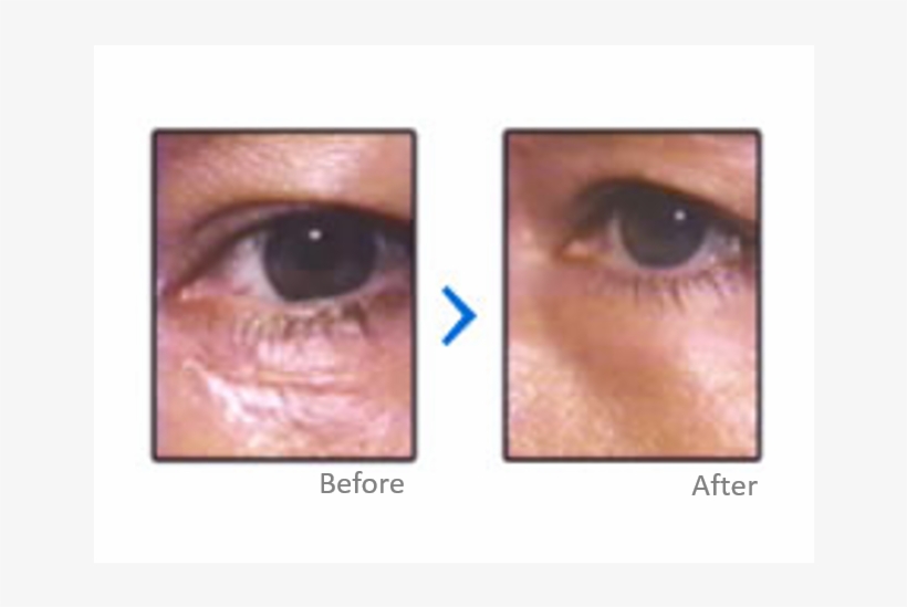 Scar Treatment Results - Contact Lens, transparent png #2968740