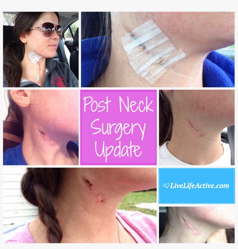 Branchial Cleft Cyst Removal Surgery Scar - Branchial Cyst Surgery Scar, transparent png #2968783