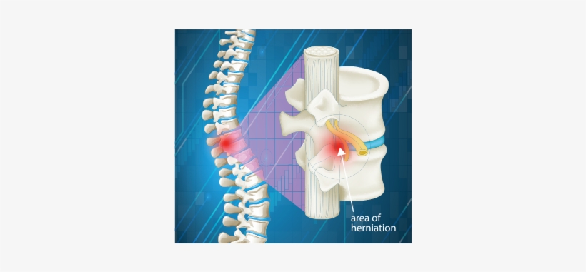 Our Chiropractors In Tucson Offer Treatment For Pinched - Area Spinal Column, transparent png #2970428