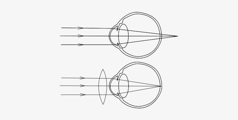 Los Rayos De Luz Que Inciden En El Ojo, Enfocan Por - Hypermetropia, transparent png #2977089