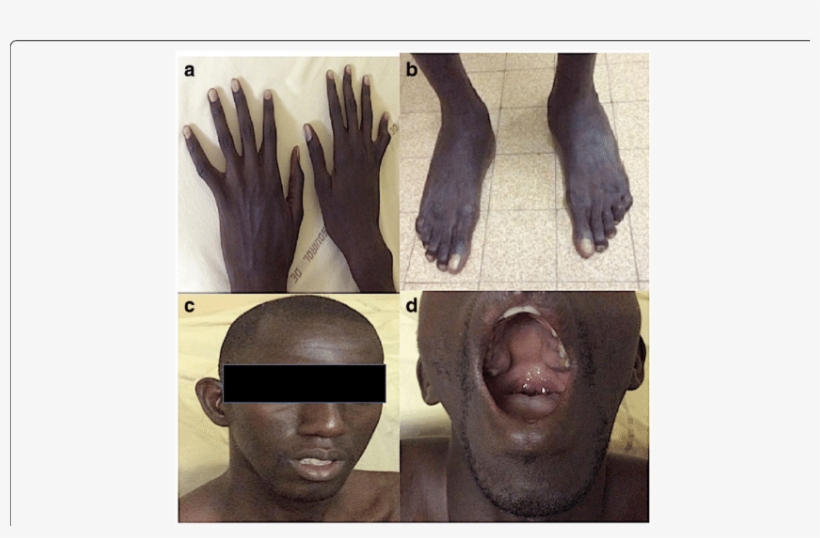 Clinical Anomalies Of A Patient - High-arched Palate, transparent png #2990654