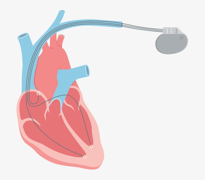 Systolic Heart Failure Also Called Systolic Left Ventricular - Labeled Diagram Of A Pacemaker, transparent png #3005816