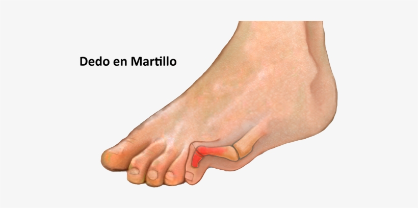 Causas - Hammer Toe, transparent png #3036326