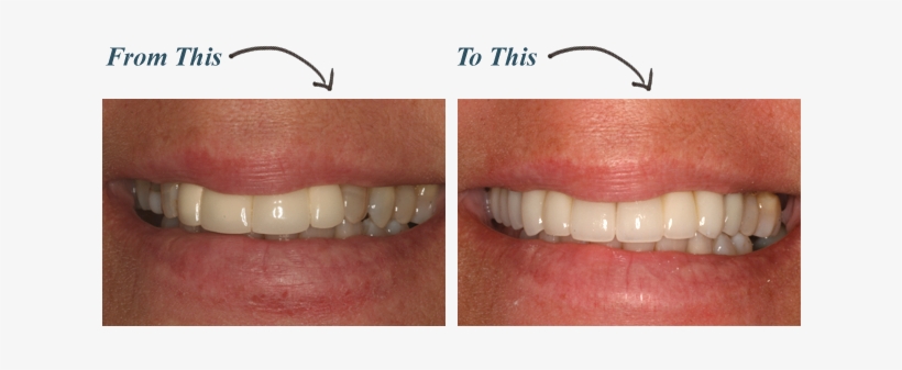 Full-mouth - Full Mouth, transparent png #3126867