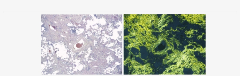 Ssc, Honeycomb-lung Characterized By Excessive Fibrous - Sea Lettuce, transparent png #3158459