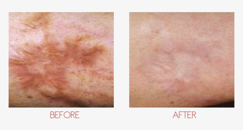Feel Confident With Your Skin - Scar, transparent png #3178731