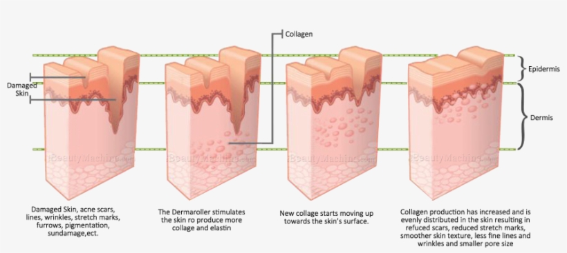 Derma Needling System Titanium Micro Needle Roller - Fine Lines And Wrinkle, transparent png #3178852