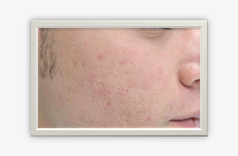 This Involves Using A Needle Or Cannula To Break The - Freckle, transparent png #3178872