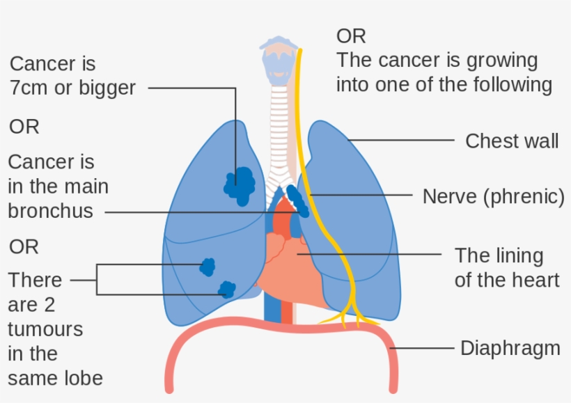 Lung Cancer Stages Pictures - Lung Cancer Staging, transparent png #3181839