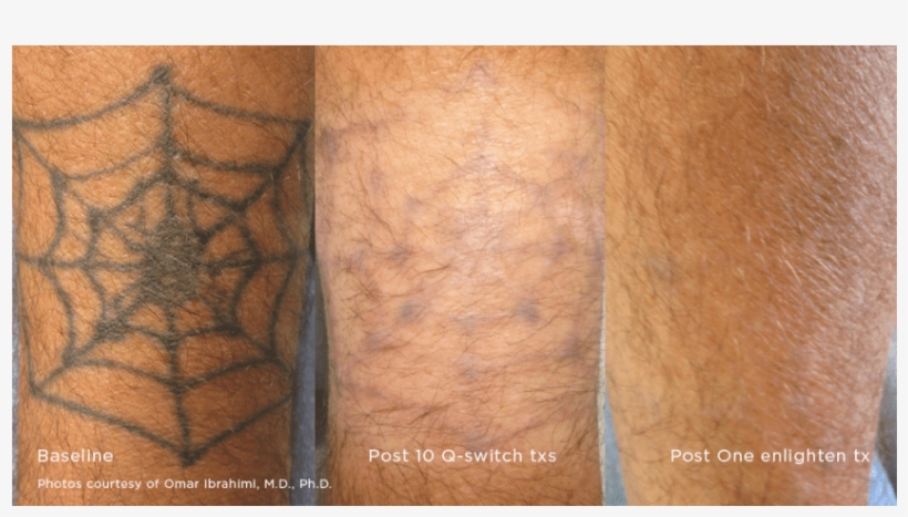 Tattoo Removal* - Tattoo, transparent png #3193664