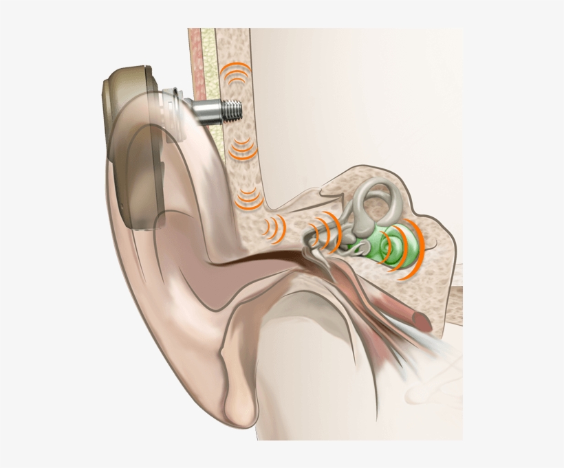 Костные слуховые аппараты неимплантируемые. Костные слуховые аппараты неимплантируемые. Костные слуховые аппараты неимплантируемые. Костные слуховые аппараты неимплантируемые. Кохлеарный имплант кохлер.
