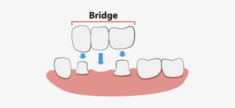Dental Bridges Illustration - Dental Bridge Illustration, transparent png #323799