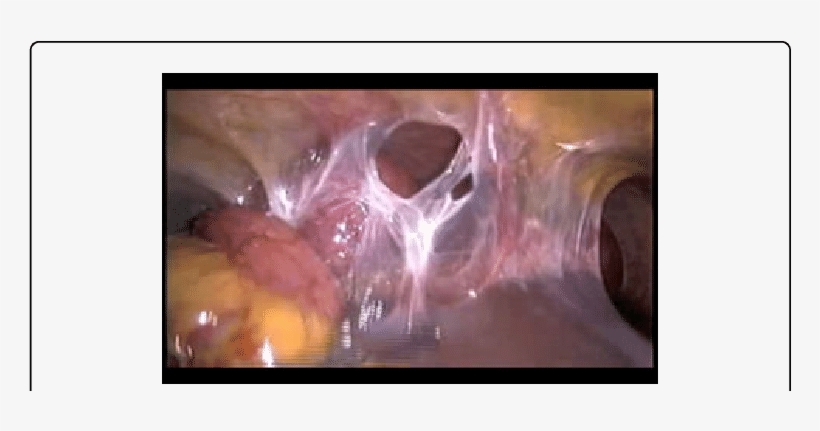 Photograph Showing The Dilated Small Intestines Trapped - Small Intestine, transparent png #3286174