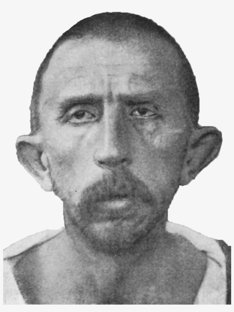 Schizophrenia Congenital Idiot, Age - Wikimedia Commons, transparent png #3293169