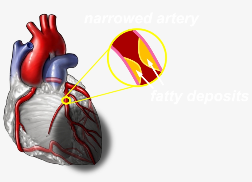 A Severe Heart Attack Can Cause Permanent Damage To - Rheumatoid Arthritis Affect Heart, transparent png #3335855
