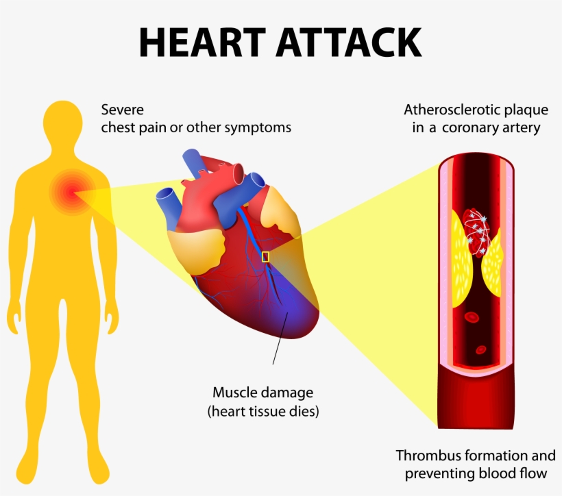 Heart-attack2 Adobestock - Myocardial Infarction Full Body, transparent png #3336087