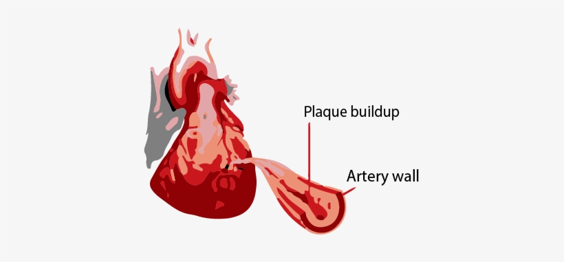 Myocardial Infarction, transparent png #3336164