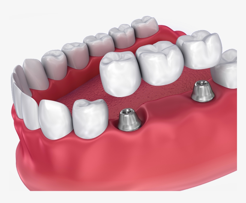 Dental Crowns, transparent png #3391114