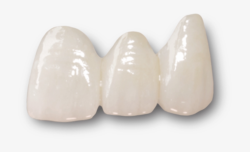 Ceramic Dental Bridges - Emax Crown, transparent png #3391491