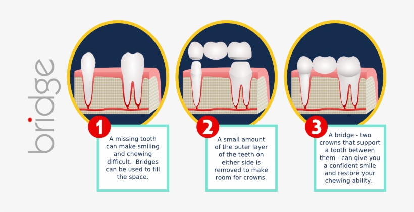 Fpd - Inlays And Onlays, transparent png #3391599