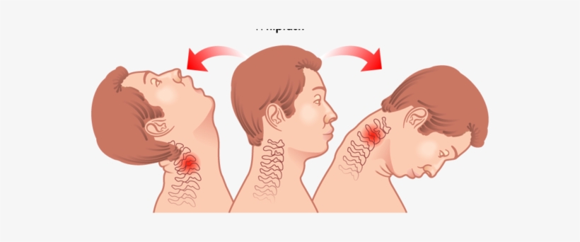Whiplash Injuries Cause Pain - Whiplash Injury, transparent png #3451118
