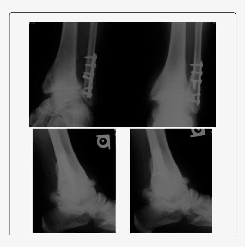 Ap, Mortise And Flexion Extension X Rays Of An Osteoarthritic - Radiography, transparent png #3505869