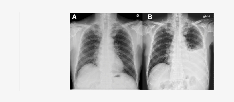 Chest X-rays Showed Normal Heart Size, Sharp Cardiopleural - Coronary Stent, transparent png #3505915