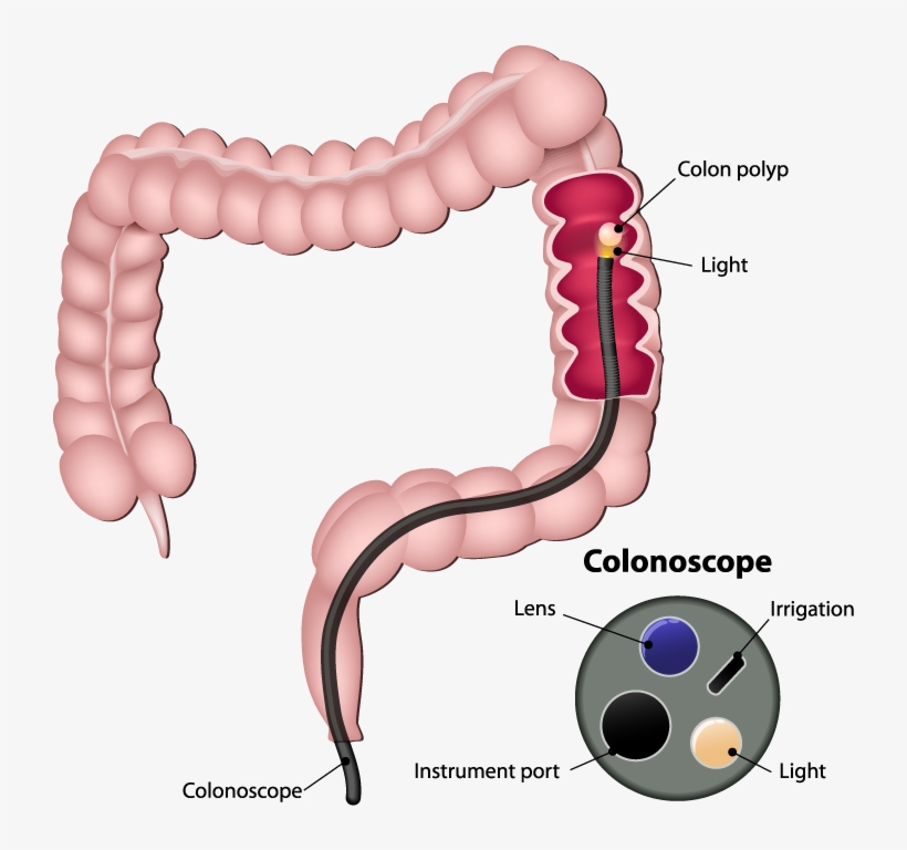 Colonoscopy - Colon Cancer, transparent png #3521752