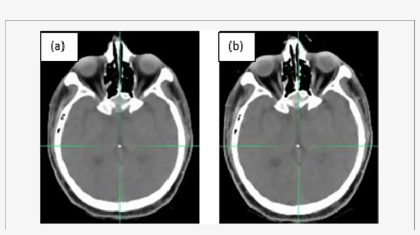 The Landmark Location On The Fixed And (b) - Computed Tomography, transparent png #3522325