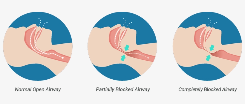 Snoring Can Affect Everyone Occasionally - Causes People To Snore, transparent png #3524043